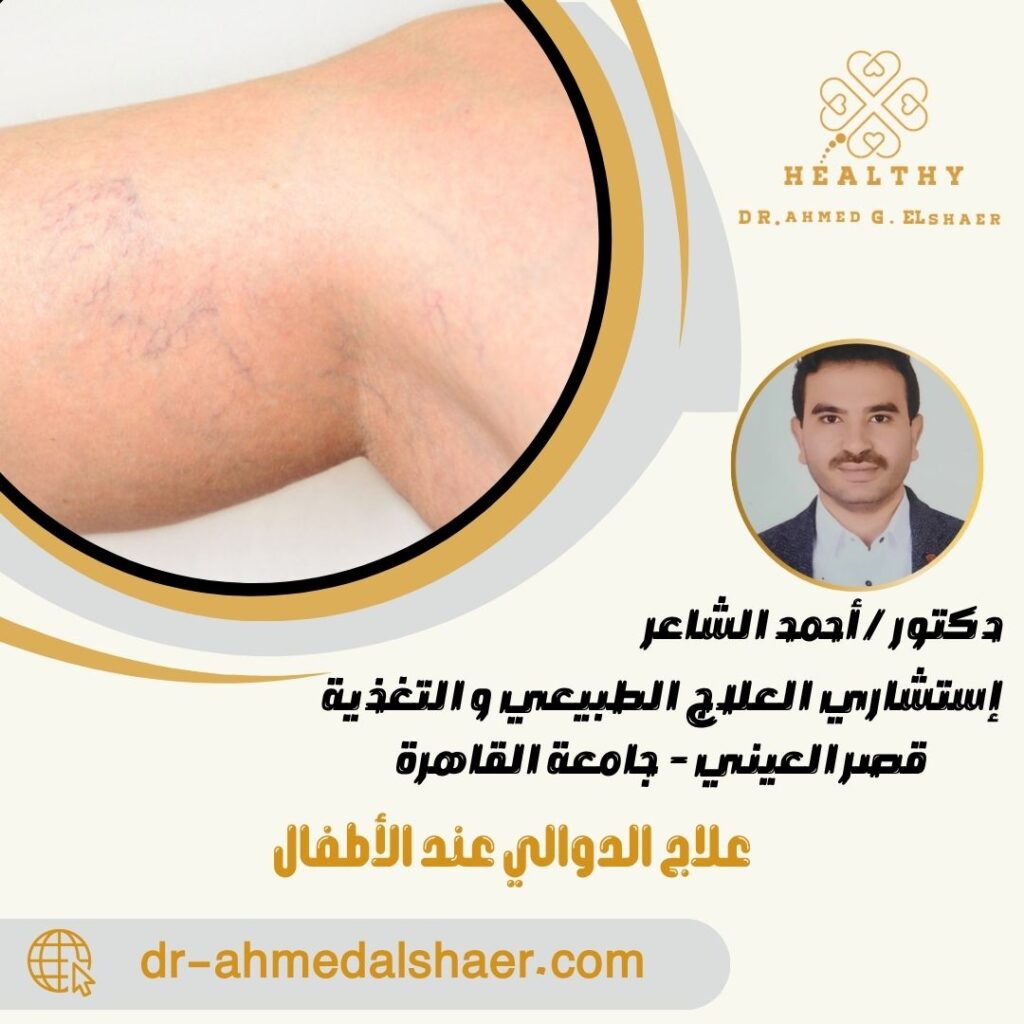 علاج الدوالي عند الأطفال