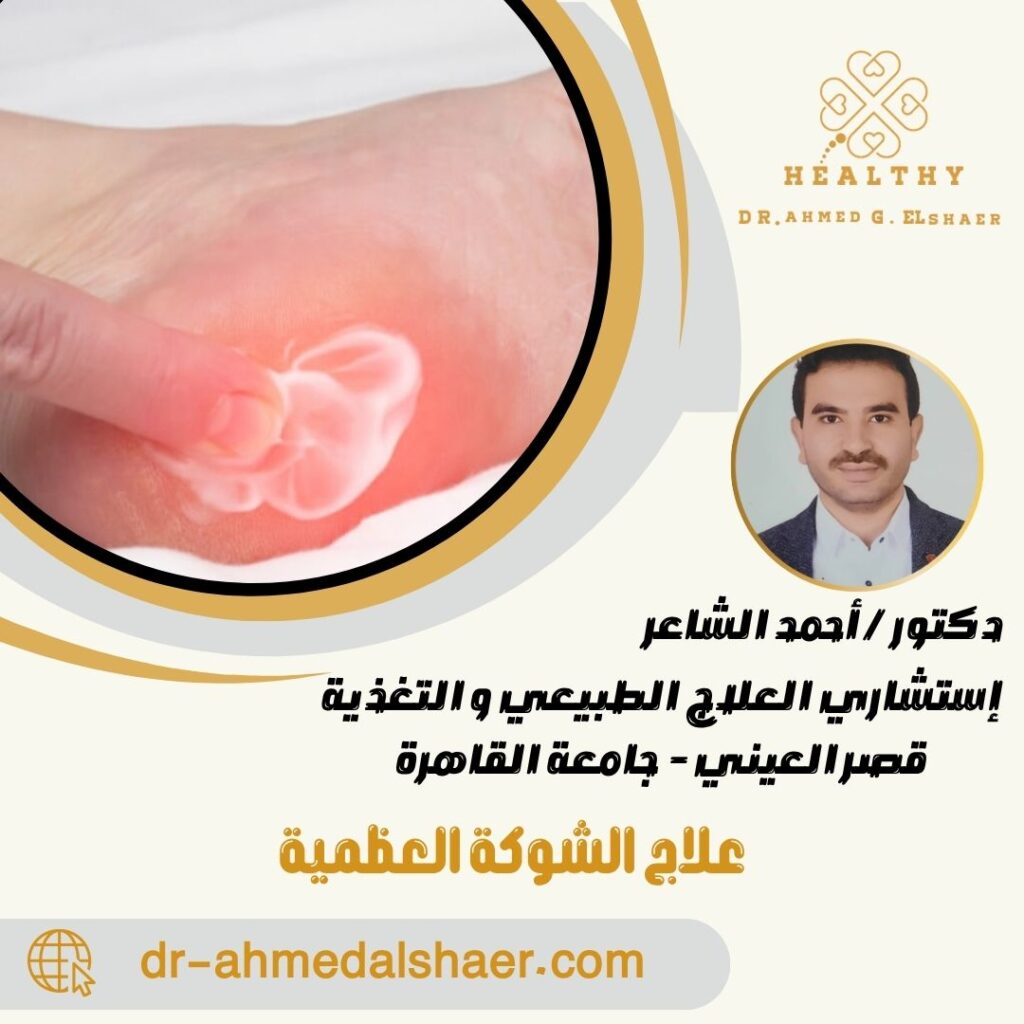 علاج الشوكة العظمية