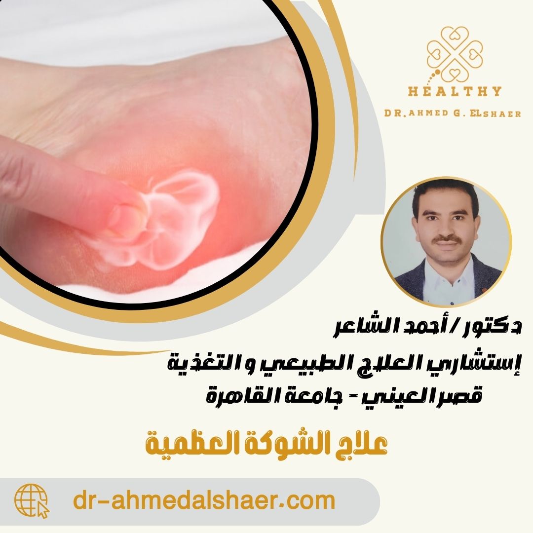علاج الشوكة العظمية